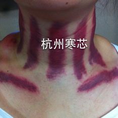 杭州寒芯中医揪痧(房号:207332370)