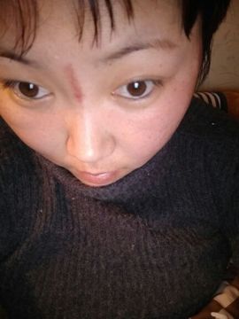 揪痧治咽炎主播照片
