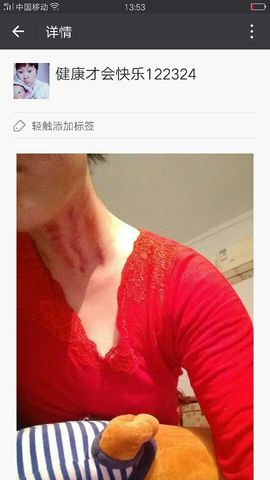 揪痧治咽炎主播照片