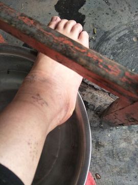 揪痧治咽炎主播照片