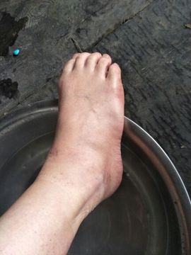 揪痧治咽炎主播照片