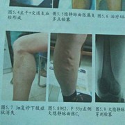 微创治疗静脉曲张，腰海报