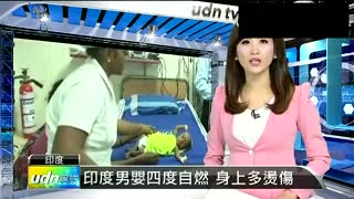 印度一3月大男婴患罕见自燃怪病 身体4次起火